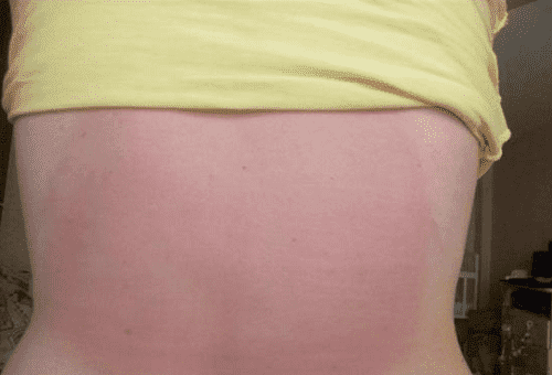 arde pe piele de la unguent finalgon