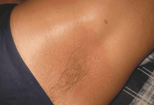 arde pe piele de la unguent finalgon